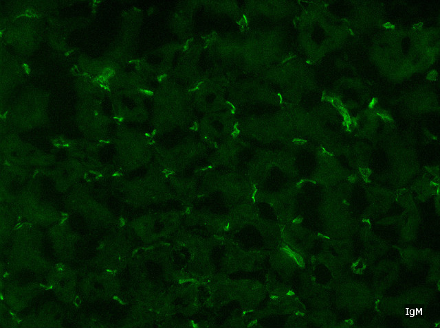 Antibody-mediated rejection