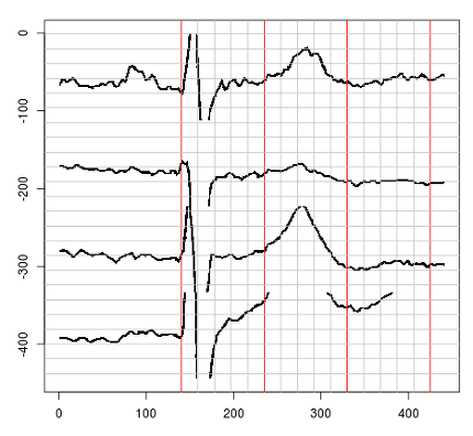 EKG handling