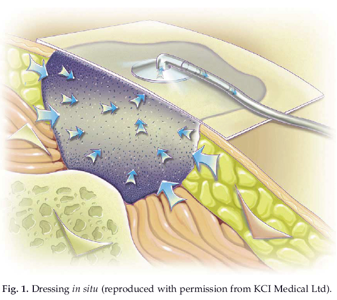 Vacuum Assisted Closure