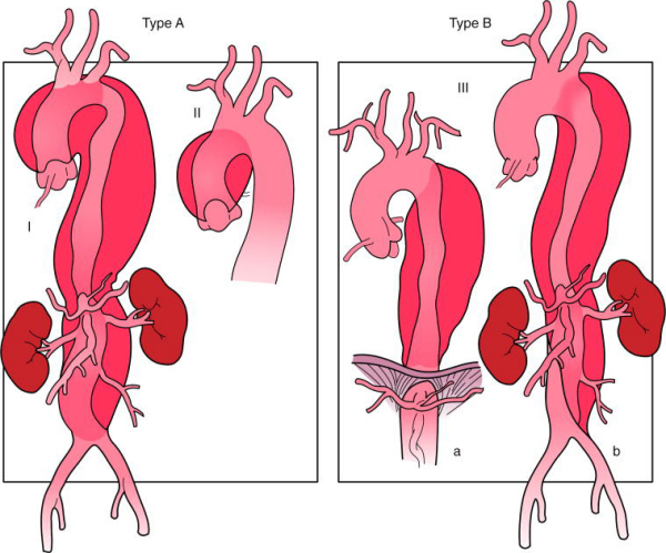 Aortic dissection