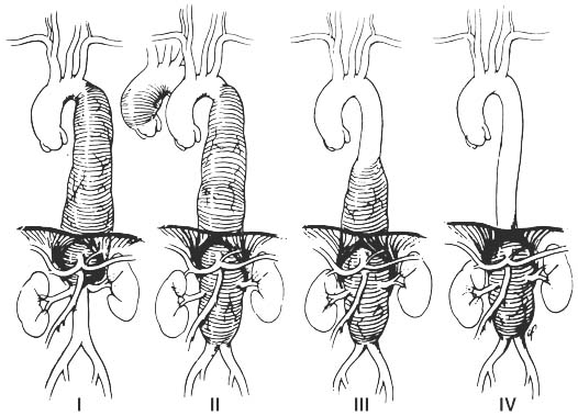 Thoracoabdominal aortic aneurysm